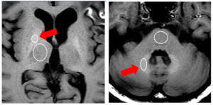 図4　ガドリニウム造影剤の脳内沈着、左図矢印：淡蒼球 右図矢印：歯状核 （文献[5] より改変引用）